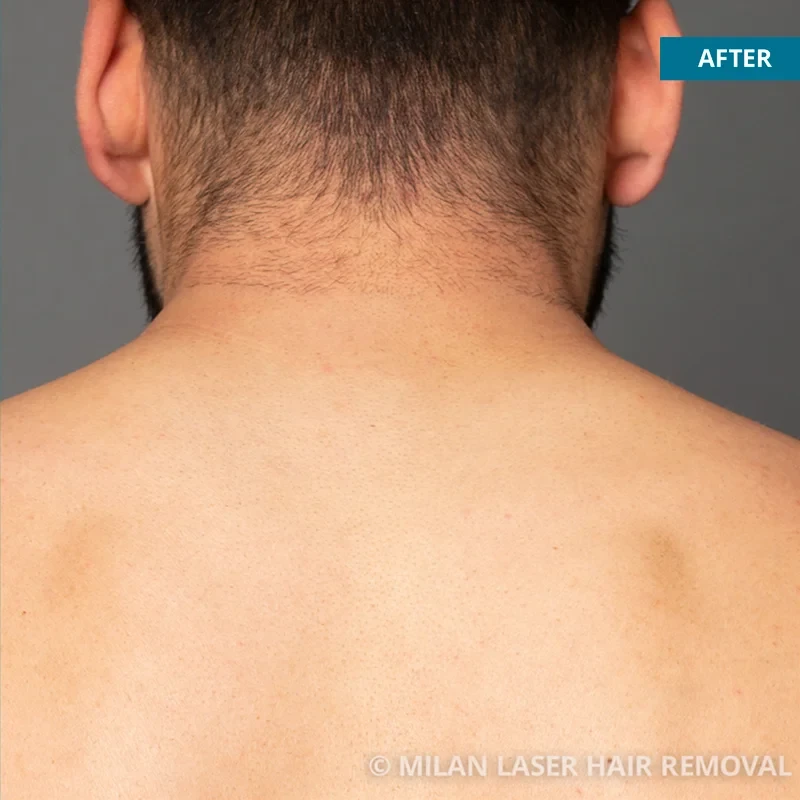Men's Before & After Photos of Laser Hair Removal | Milan Laser in Houston,  TX
