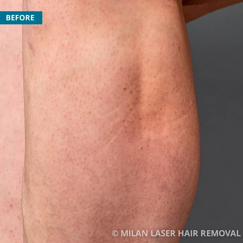 Legs and Feet Before & After Photos of Laser Hair Removal | Milan Laser in  Houston, TX