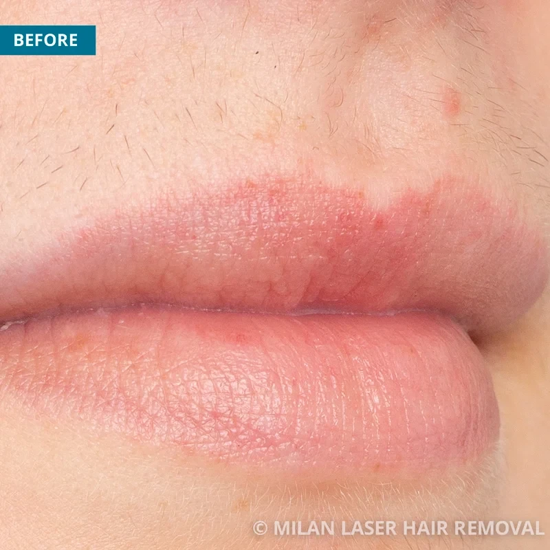 Face Before & After Photos of Laser Hair Removal | Milan Laser in Houston,  TX