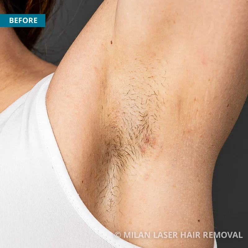 Underarm Before & After Photos of Laser Hair Removal | Milan Laser in  Houston, TX